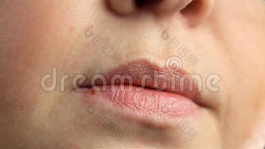 女人嘴唇上有疱疹，疱疹。 唇部治疗，慢镜头拍摄，复制空间